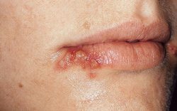 Cold Sores - PatientSmart
