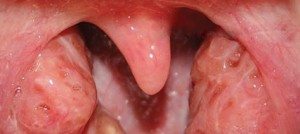 Cryptic Tonsils