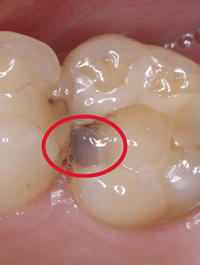 Decay can even form under a filling.