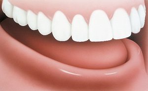 Implant Dentures Before - PatientSmart