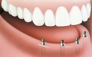 With implants and posts (abutments) - PatientSmart