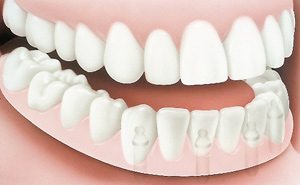 Implant Dentures After - PatientSmart