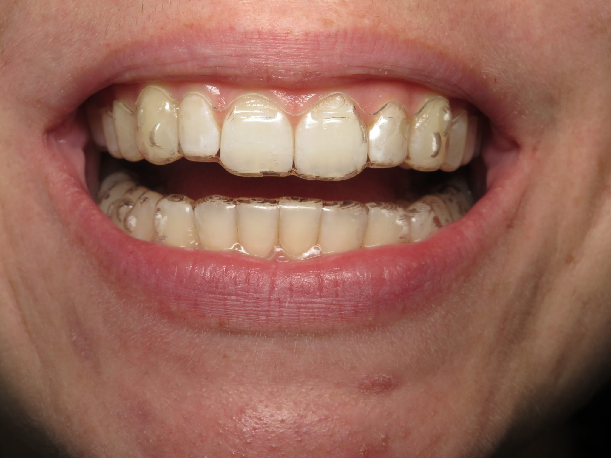 What do Invisalign buttons look like? • Seasons of Smiles Dental