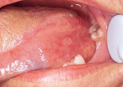 Erythroplakia - PatientSmart