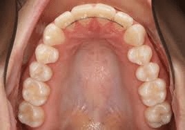 Fixed Wire Retainer