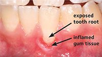 Gum recession of a crooked tooth