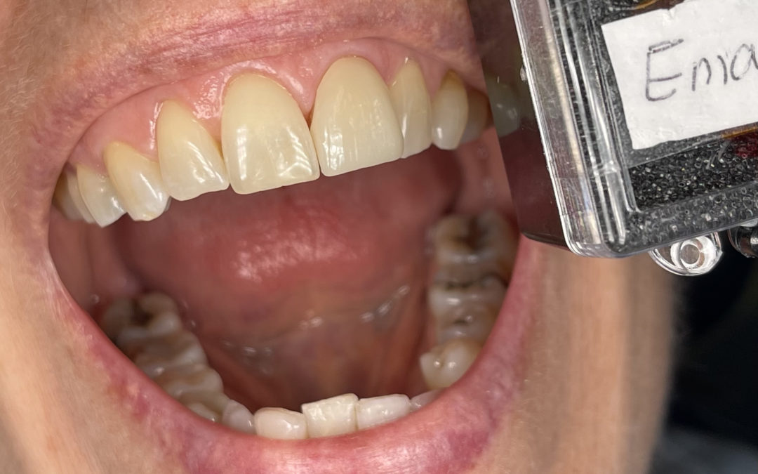 What are the best esthetic dental crown materials options? 2021