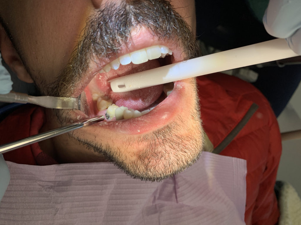 Jason's tooth #30.
