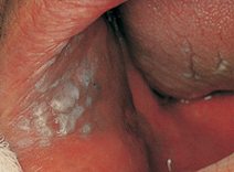 Leukoplakia (which can turn into cancer) inside the cheek