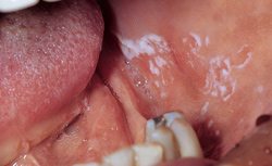 Leukoplakia - PatientSmart