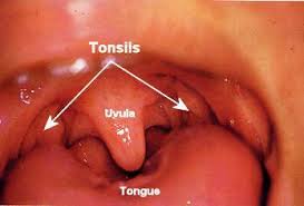 Tonsillar Stones - Seasons of Smiles