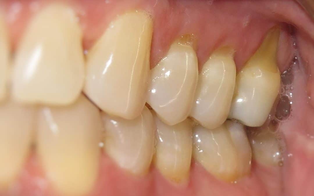 Gum Recession: It’s About More Than Just Brushing Too Hard