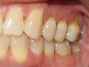 Gum Recession: It's About More Than Just Brushing Too Hard