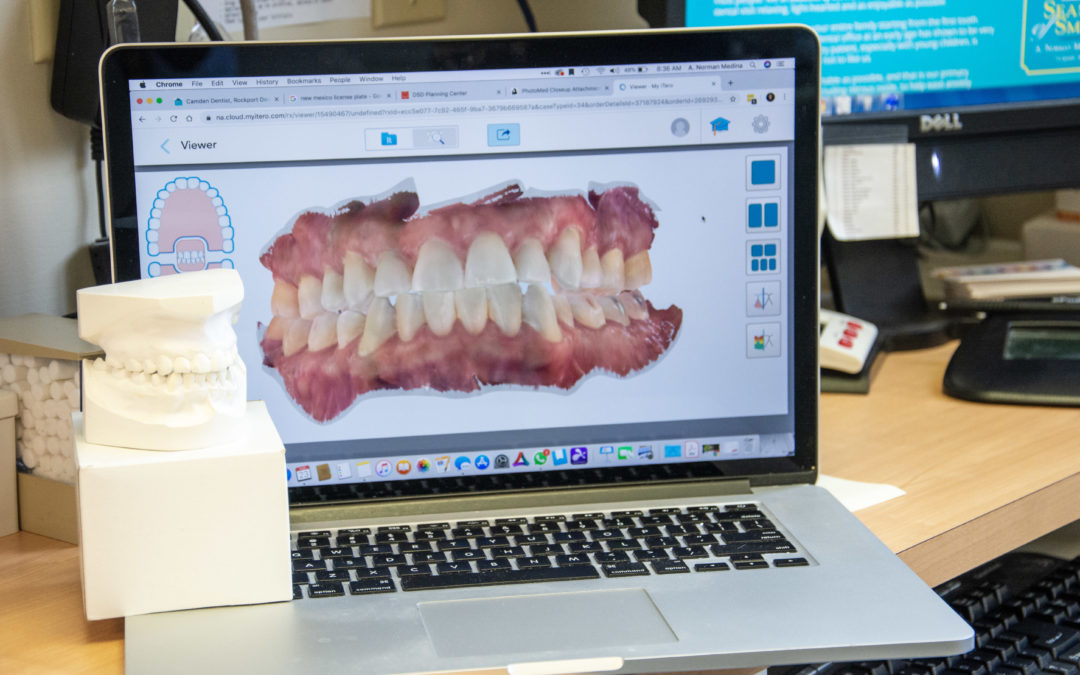 STL files vs Alginate Impressions