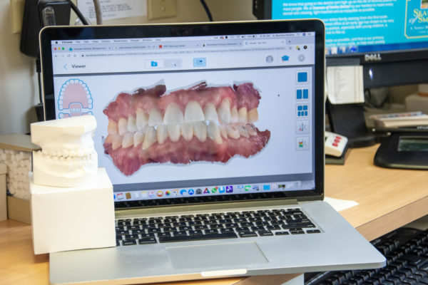 Dentistry is changing, alginate models are on their way out, STL files are the new and improved way.