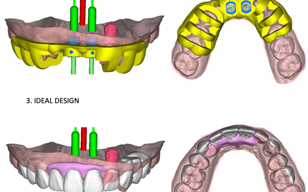 Benefits of Computer-Guided Implant Placement