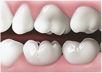 A small crack in the tooth - Cracked Tooth - PatientSmart 