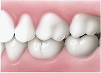 Crack widens when teeth bite down - Cracked Tooth - PatientSmart