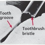Even a toothbrush bristle is too big to reach inside a groove in the tooth (magnified).