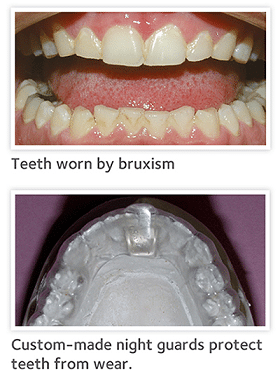 Do You Grind Your Teeth?