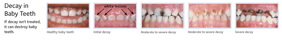 decay in baby teeth