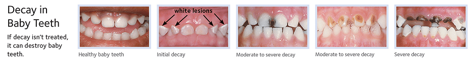 Baby teeth decay