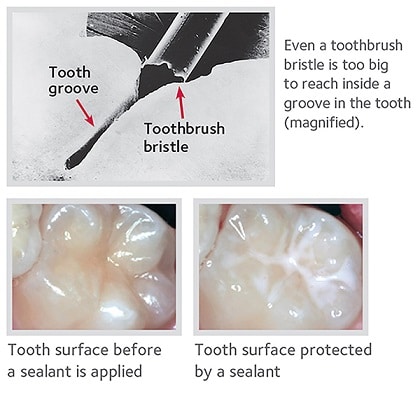 Tooth surface