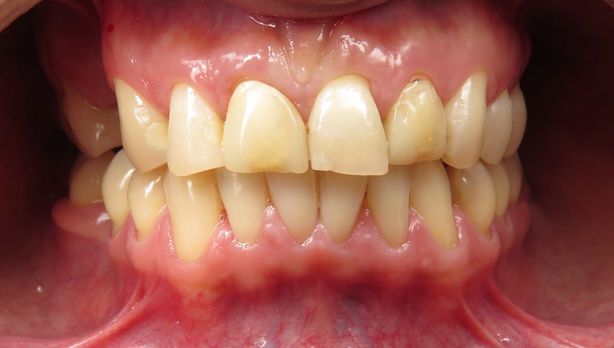 What Do Zirconium Crowns Look Like Seasons Of Smiles Dental Arthur Norman Medina DDS