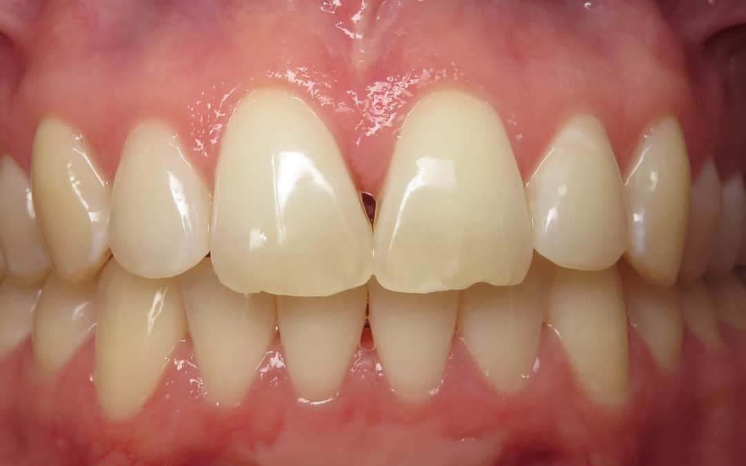 What are dental black triangles?