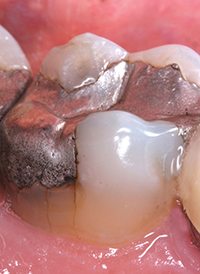 A cracked tooth with a large filling - PatientSmart