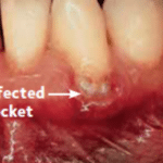 Infected Pocket - Before treatment