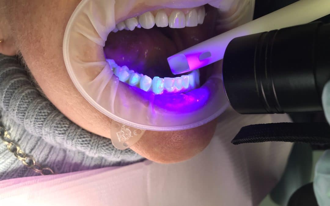 Removing Invisalign Buttons the Right Way