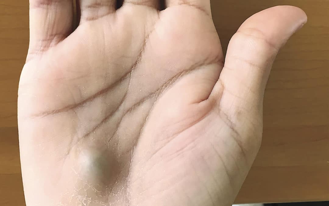 Did a dentist cause the oral infection to travel to his heart and hand?