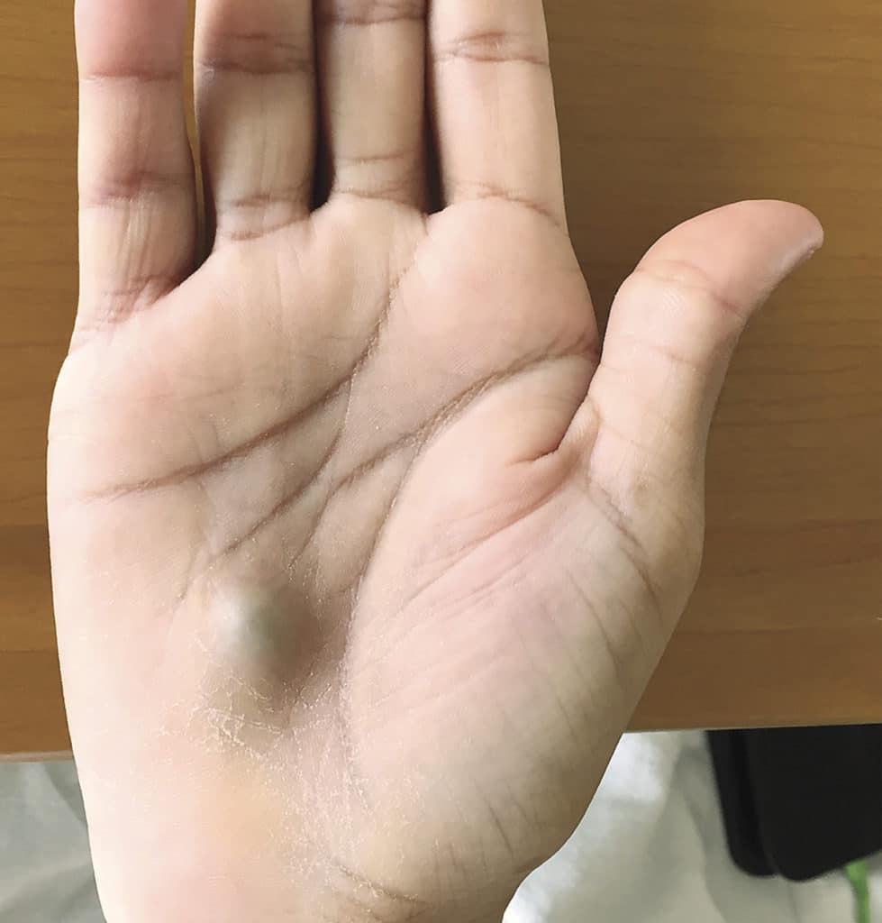 An infected hand caused from a routine dental visit?