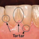 Before professional dental cleaning