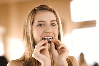 Tooth Whitening using custom trays.