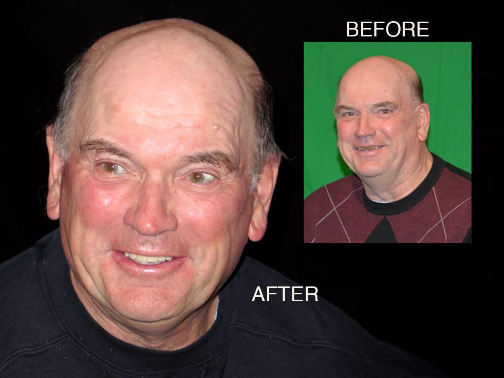Bill Curtis's new smile makeover at Seasons of Smiles Dental before and after photos